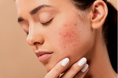 O čem vypovídá akné na obličeji podle tradiční čínské medicíny?